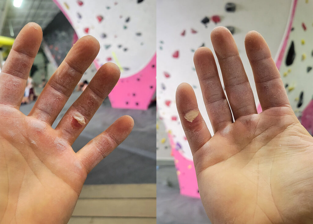 Dustin's hands in bad shape after too much rock climbing at Hollywood Boulders